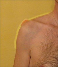 Foto simulata aura_articolazioneinfiammata_episcienzaebiofotoni