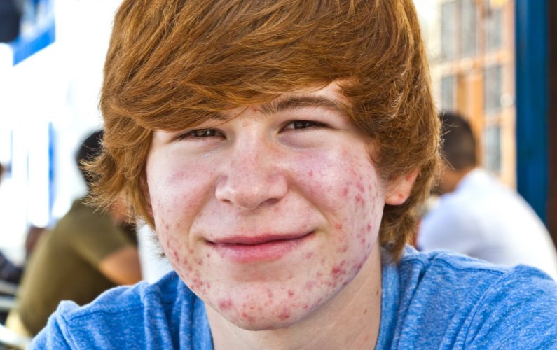 Acne_episcienzaebiofotoni