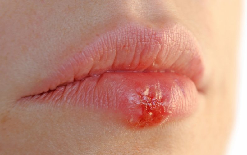 Herpes simplex_episcienzaebiofotoni