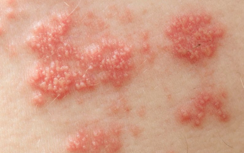 Herpes zoster_episcienzaebiofotoni